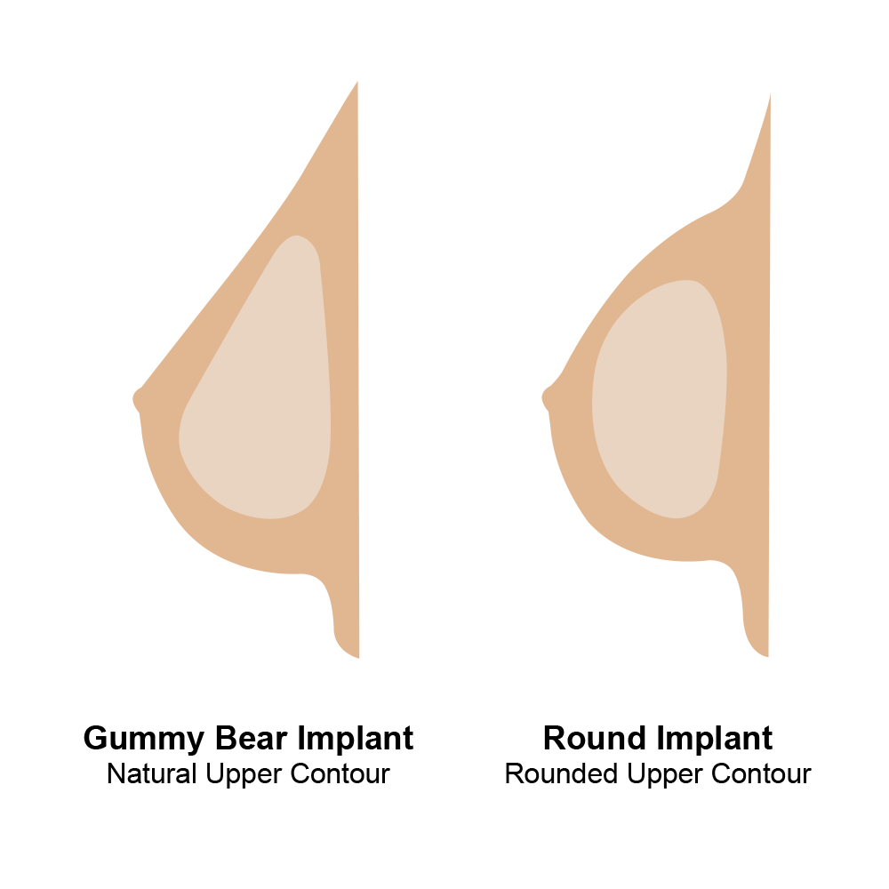 Comparison of Round and Teardrop Breast Implants