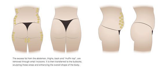 Differences Between Fat Transfer And Implants For A Butt Lift